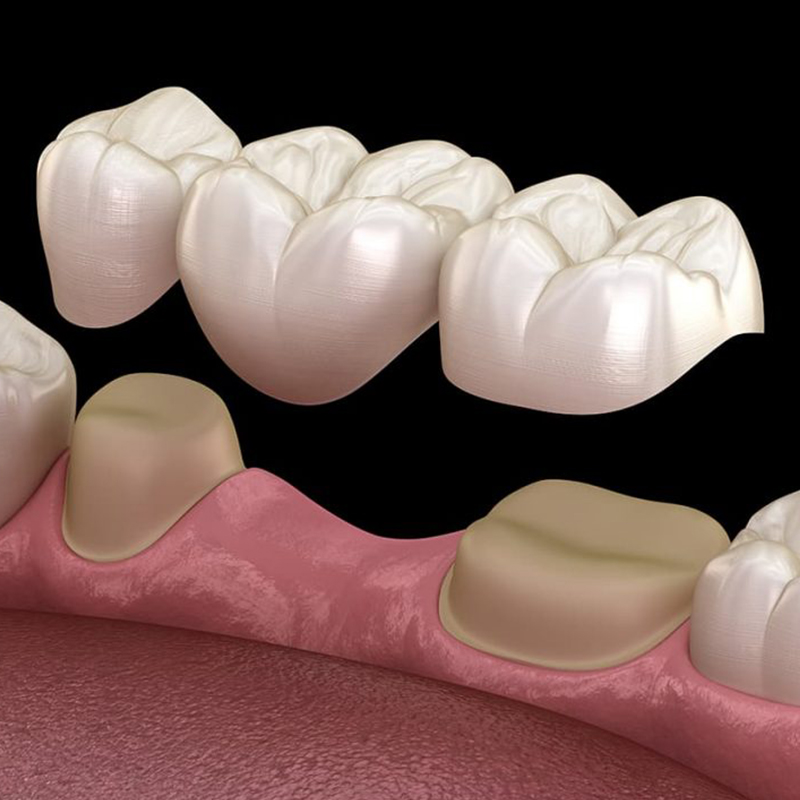 Geleneksel bir diş köprüsü 3 ila 4 ardışık krondan oluşur. Geleneksel köprülere uygun olmak için her boşluğun sonunda sağlıklı…